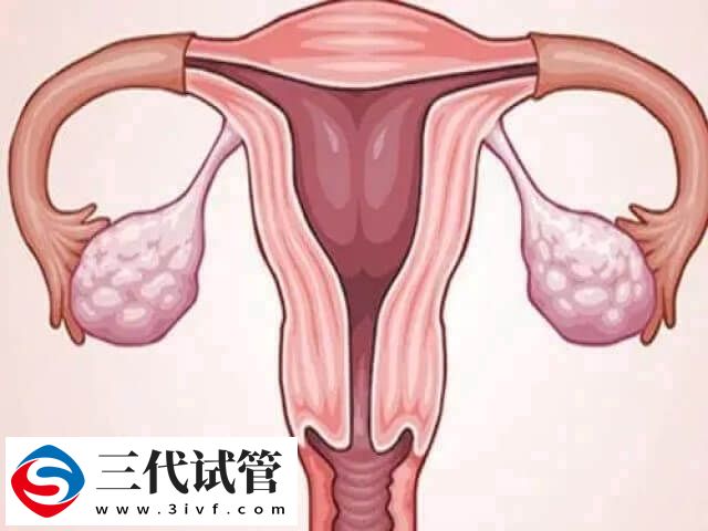 子宮疤痕憩室可不可以做試管嬰兒(圖1)