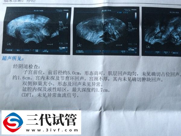 線性內(nèi)膜后建議再等等，何時(shí)做試管嬰兒移植要看個(gè)體情況(圖2)