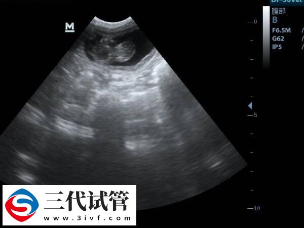 一文解讀試管嬰兒胎停時(shí)間與原因，早知道早預(yù)防(圖1)