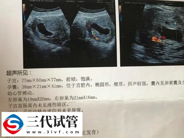 一文解讀試管嬰兒胎停時(shí)間與原因，早知道早預(yù)防(圖2)