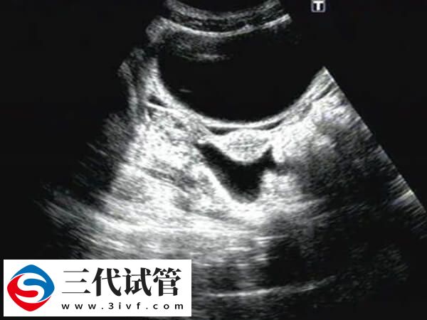 鮮胚移植后宮腔積液多久能吸收(圖1)