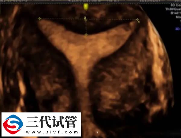 鮮胚移植后宮腔積液多久能吸收(圖2)