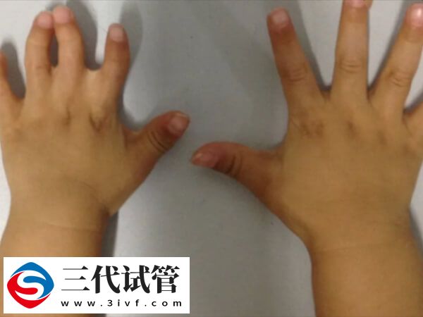 apert綜合征能做三代試管要二胎嗎？(圖1)